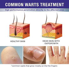 Load image into Gallery viewer, Dr. Luke Liquid Wart & Corn Gel Maximum Strength Exclusive Formula Common and Flat Wart Liquid, Fast-Acting Corn Removal Mask for Plantar