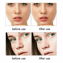 Load image into Gallery viewer, Age Spot Mole Wart Freckle Tattoo Removal Machine Laser Pen Skin Tag Remover Pen