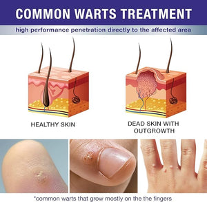 Dr. Luke Liquid Wart & Corn Gel Maximum Strength Exclusive Formula Common and Flat Wart Liquid, Fast-Acting Corn Removal Mask for Plantar