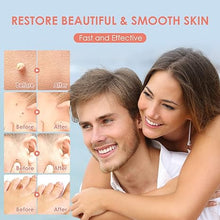 Load image into Gallery viewer, Midjustty Skin Removal Kit Tools Accessory for Home Use, Safe and Effective Skin Remover Kit
